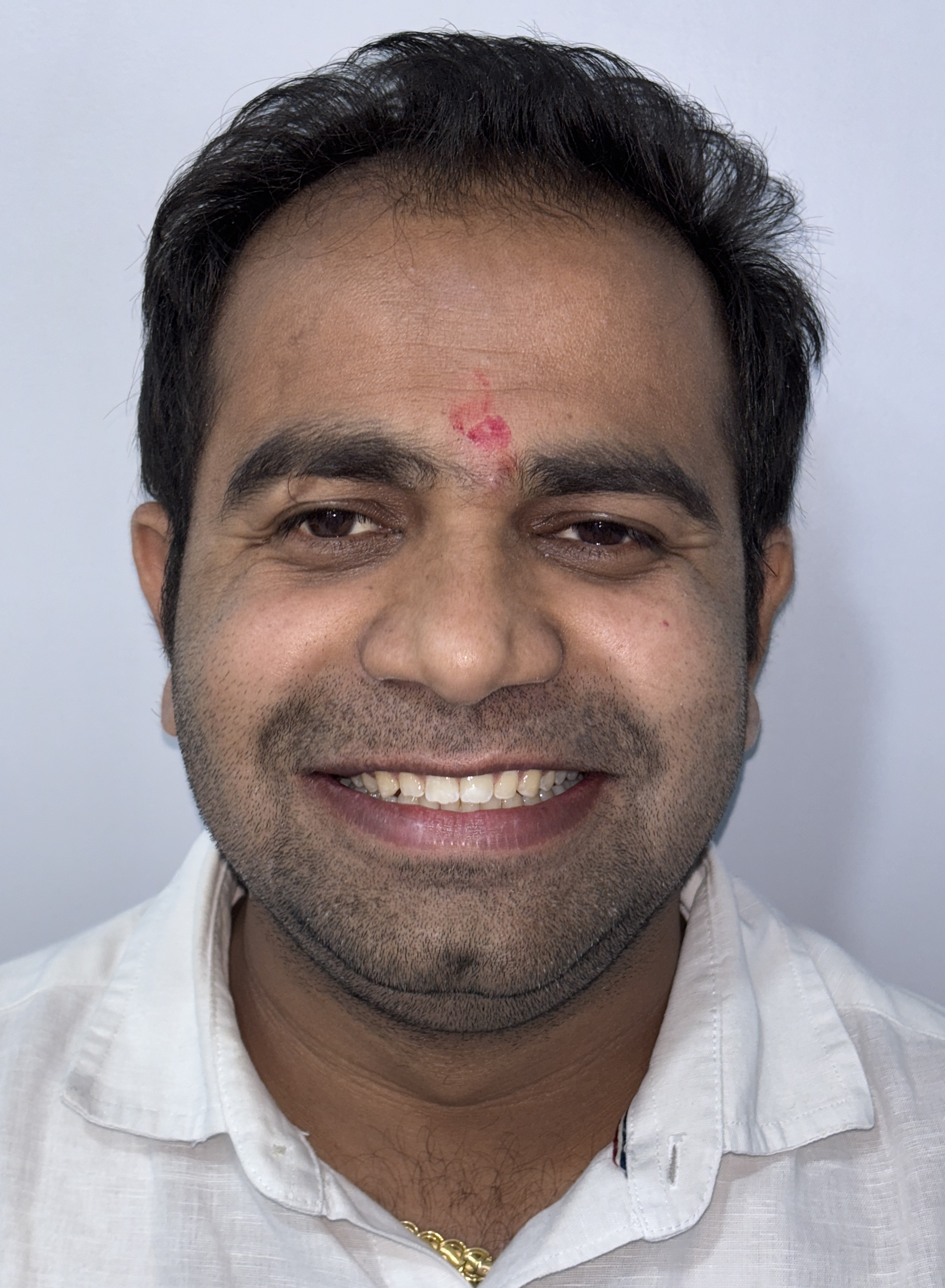 Corrected Open Bite & Spacing - After Invisalign Aligner Treatment